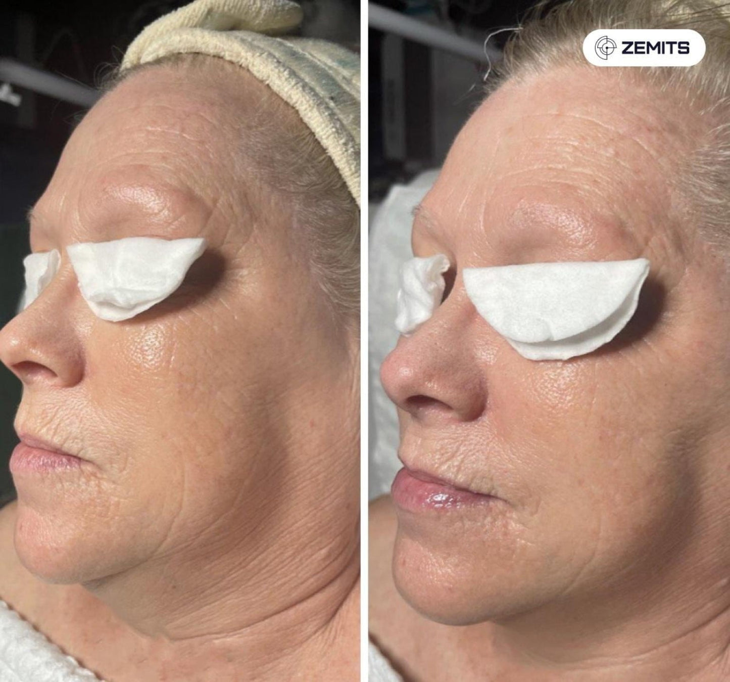 Zemits Klein EL Sistem de Electroporare