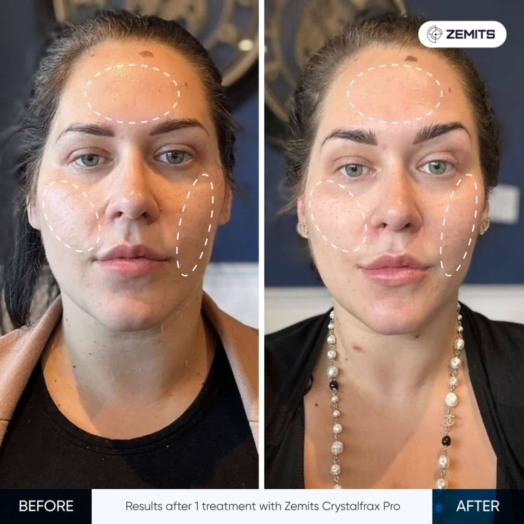 Zemits CrystalFrax PRO Sistem fracțional RF neinvaziv