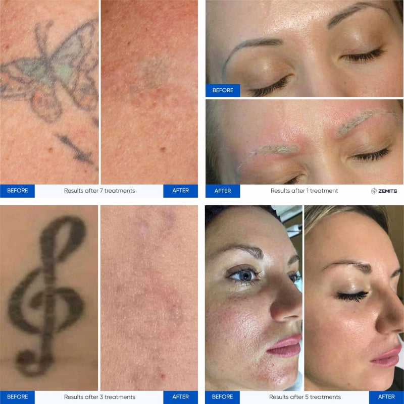 Zemits YAGenix Laser Nd:YAG comutat Q