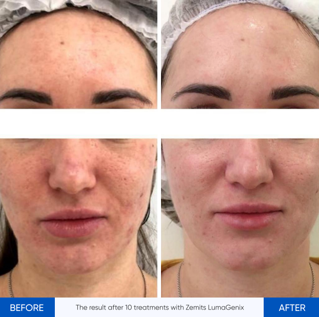 Zemits LumaGenix PDT Dispozitiv Profesional de Terapie cu Lumină LED