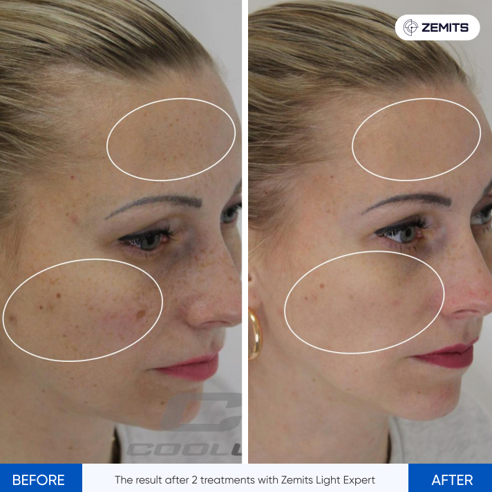 Zemits Light Expert 2.0 Aparat Laser IPL