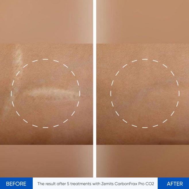 Zemits CarbonFrax Pro: Laser fracțional CO2