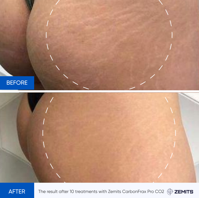 Zemits CarbonFrax Pro: Laser fracțional CO2