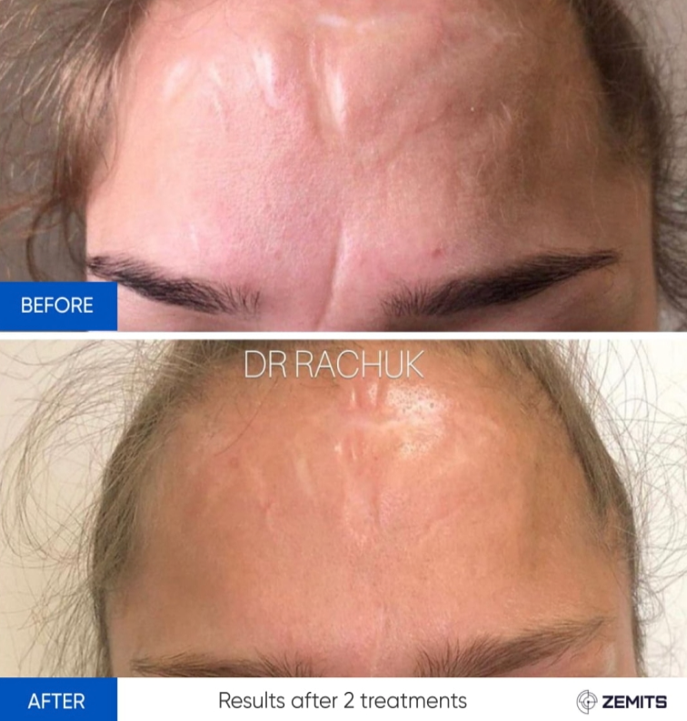 Zemits CarbonFrax Pro: Laser fracțional CO2