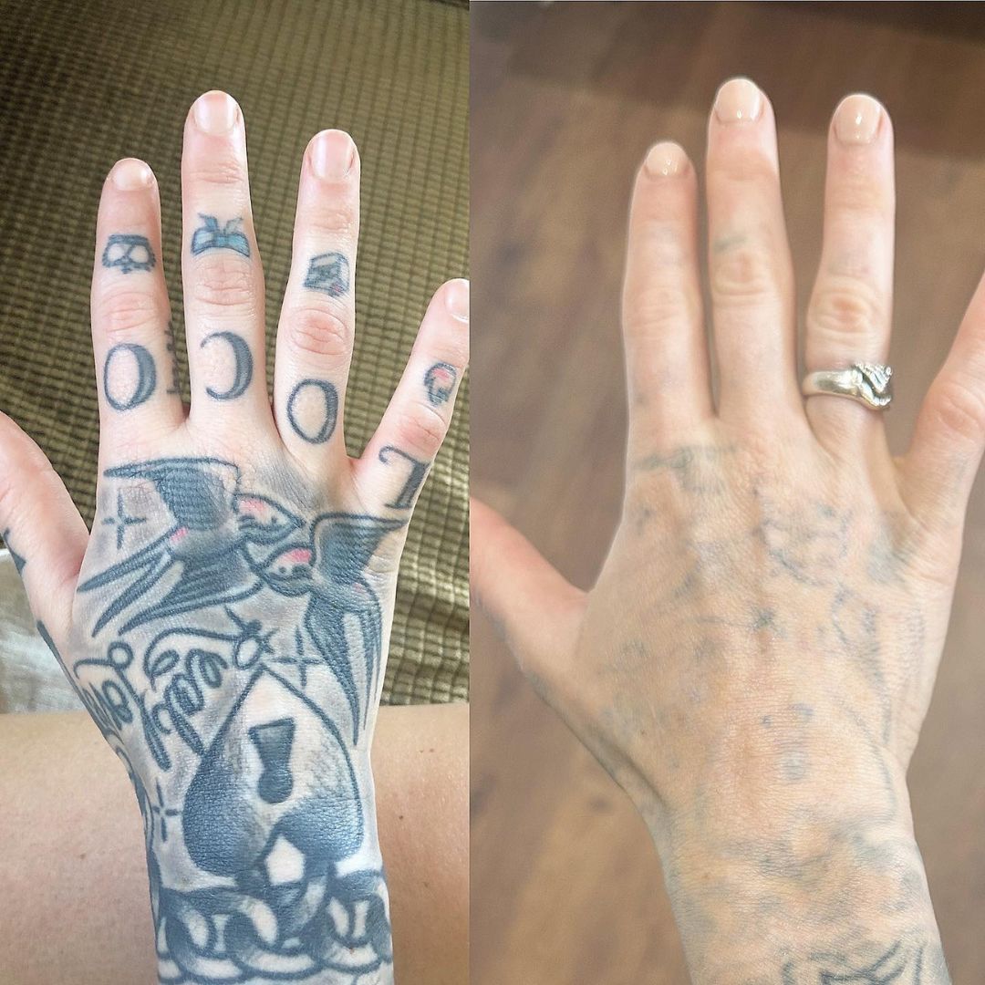 Zemits YAGenix Laser Nd:YAG comutat Q