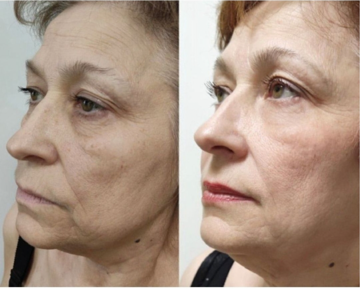 Zemits LumaGenix PDT Dispozitiv Profesional de Terapie cu Lumină LED