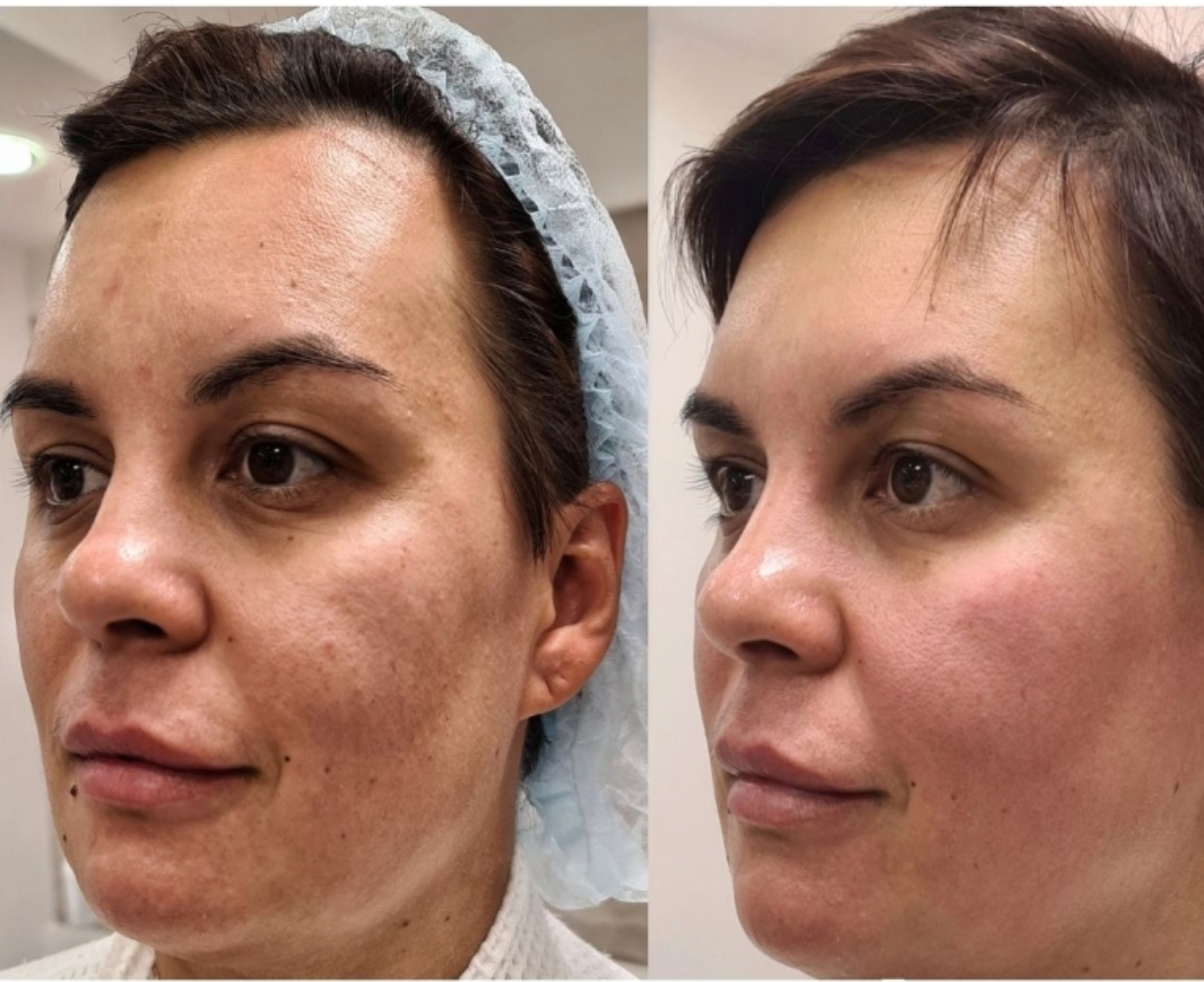 Zemits LumaGenix PDT Dispozitiv Profesional de Terapie cu Lumină LED