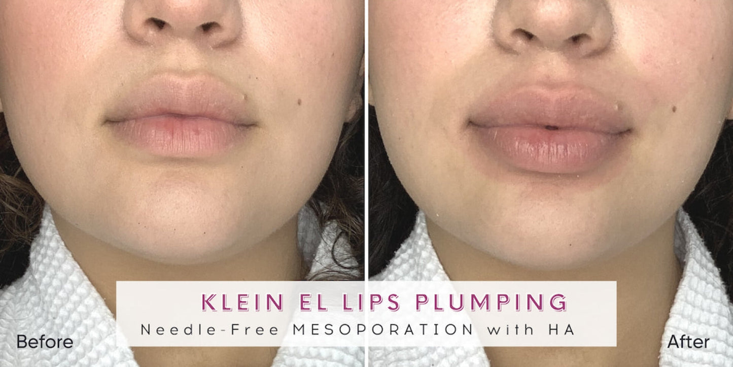 Zemits Klein EL Sistem de Electroporare