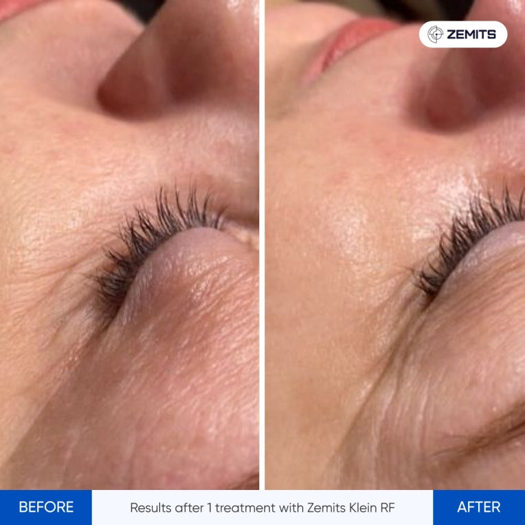 Zemits Klein RF Sistem de Strângere a Pielii