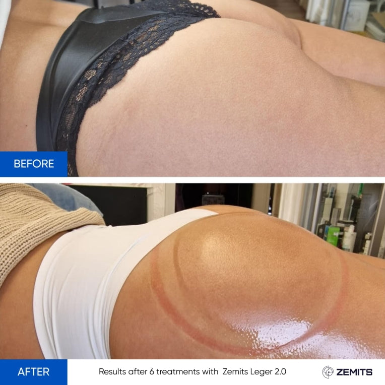 Zemits Leger 2.0 Sistem de Vacuum Cupping cu Cupe XXL în Set