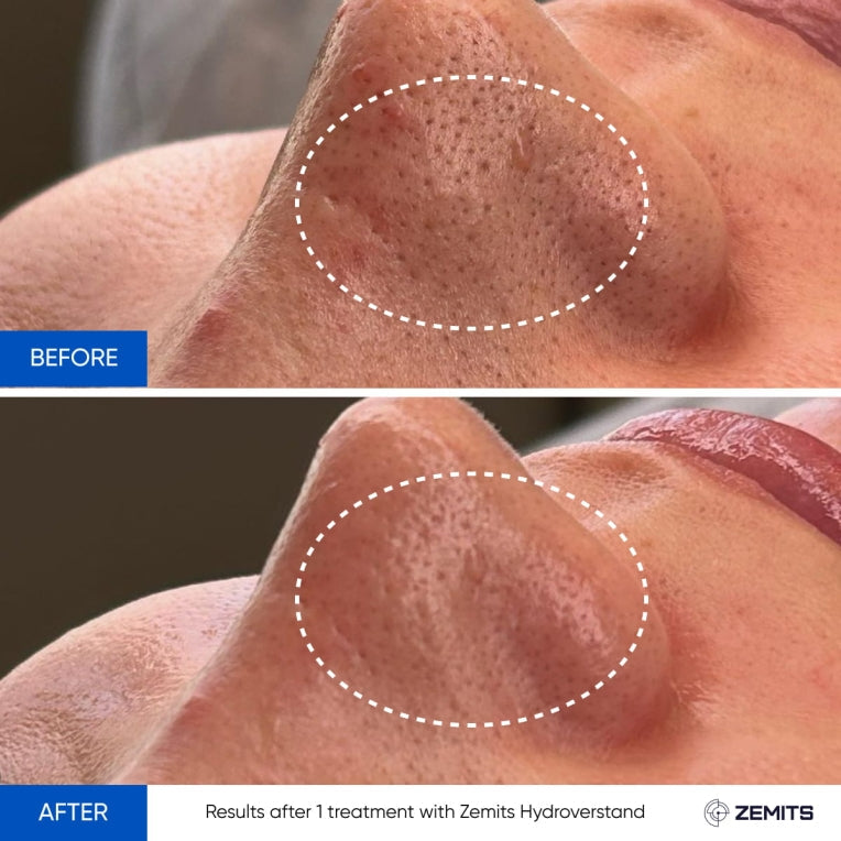 Zemits HydroVerstand PRO Sistem 7-în-1 HydroDiamond™